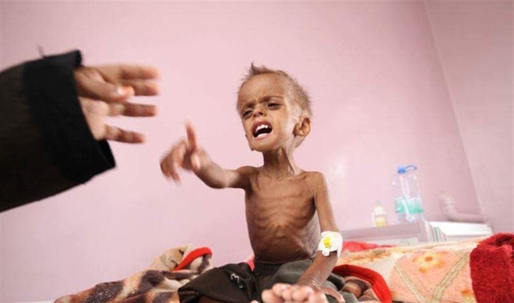 الصحة العالمية: 320 ألف طفل يمني يعانون من سوء التغذية