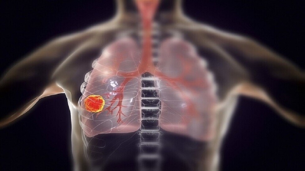 اكتشاف علمي :ثلاثة أنواع من الادوية الشائعة تمنع الإصابة بسرطان الرئة
