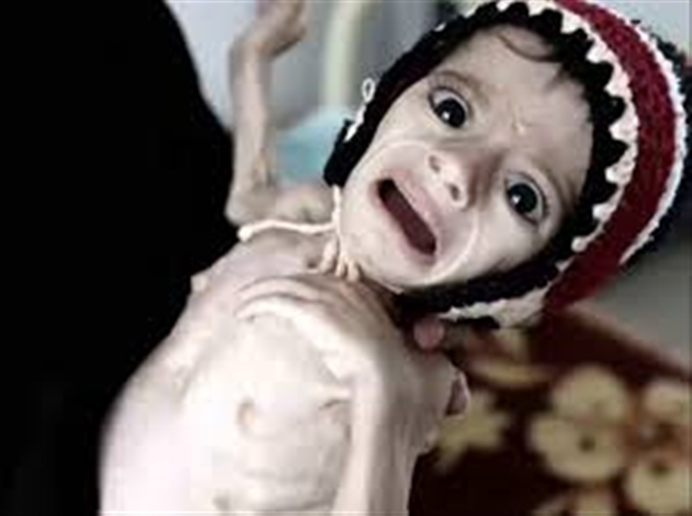 دعا إلى اتخاذ إجراءات عاجلة ...تقرير حديث للامم المتحدة : اليمن يقترب من حافة المجاعة