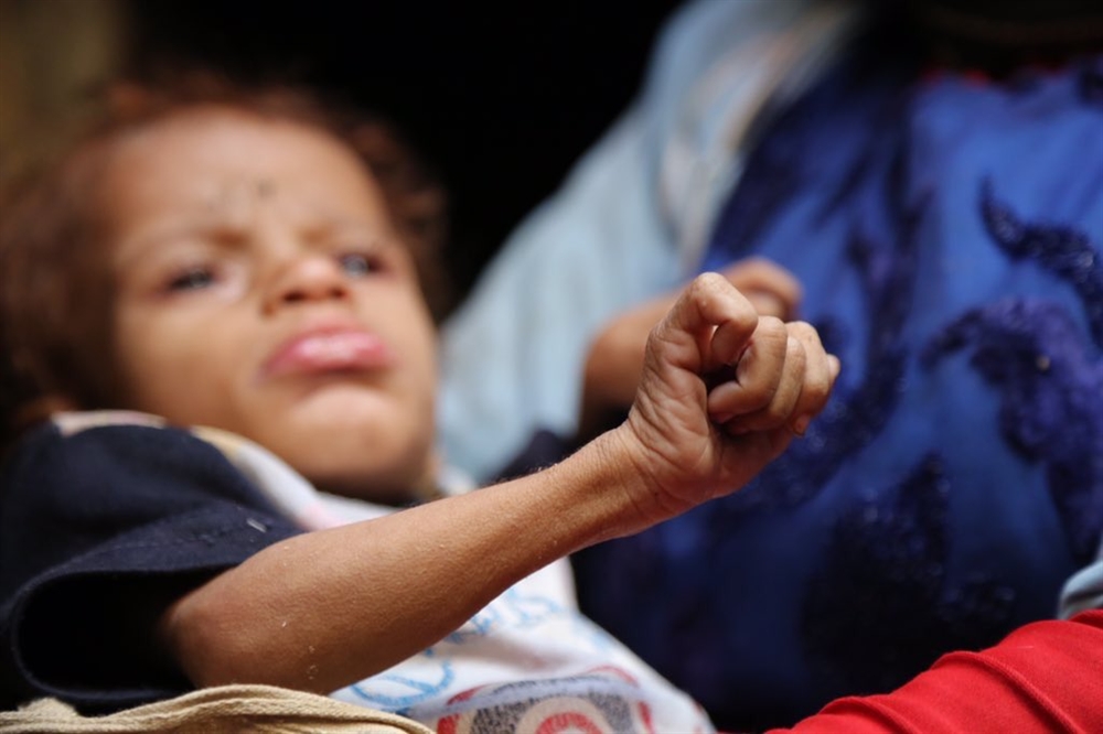 الأمم المتحدة: 7 ملايين يمني يعانون من سوء التغذية